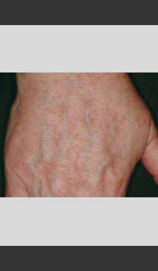 After Photo for Vbeam Laser Treatment of Pigmentation -  - Prejuvenation