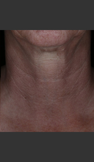 After Photo for Alastin Skincare Restorative Neck Complex with TriHex Technology® -  - Prejuvenation
