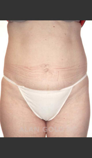Before Photo for Abdominoplasty 286 - Alan Gold MD - Prejuvenation