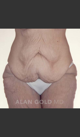 Before Photo for Circumferential Body Lift 367 - Alan Gold MD - Prejuvenation