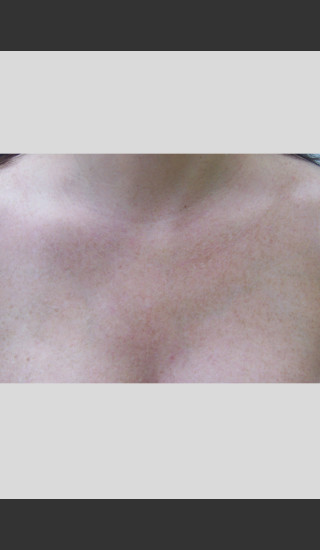 After Photo for Gentle Laser Skin Rejuvenation Treatment -  - Prejuvenation