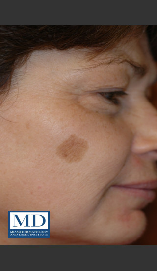 Before Photo for Brown Spots Treatment 114 - Jill S. Waibel, MD - Prejuvenation