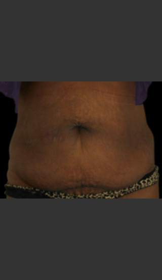 After Photo for Body Contouring Treatment #115 -  - Prejuvenation