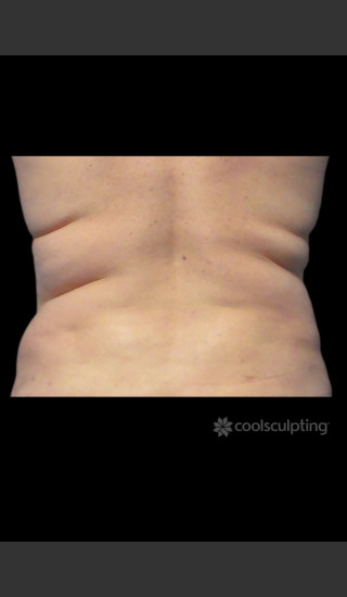 Before Photo for CoolSculpting on Woman's Love Handles -  - Prejuvenation