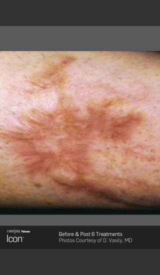 Before Photo for Scar Reduction Using Icon 1540 -  - Prejuvenation