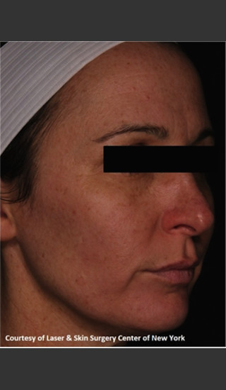 After Photo for Facial Skin Rejuvenation with Clear and Brillant Permea - Roy G. Geronemus, M.D. - Prejuvenation