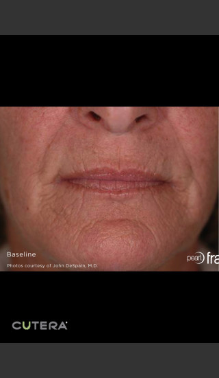 Before Photo for Pearl Fusion Resurfacing of Wrinkles -  - Prejuvenation