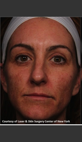 Before Photo for Full face Treament with Fraxel - Roy G. Geronemus, M.D. - Prejuvenation