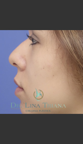 Before Photo for Rhinoplasty Female Patient - Lina Triana, MD - Prejuvenation