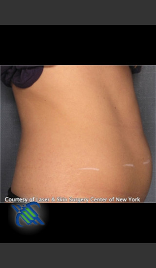 Before Photo for Treatment of Lower Abdomen Right Side - Roy G. Geronemus, M.D. - Prejuvenation