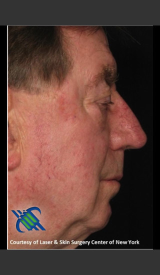 After Photo for Male Full Face Fraxel Treament - Roy G. Geronemus, M.D. - Prejuvenation