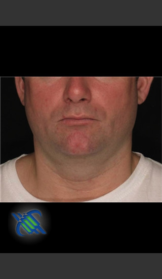 Before Photo for Treatment of Male Neck with Laser Liposuction - Roy G. Geronemus, M.D. - Prejuvenation