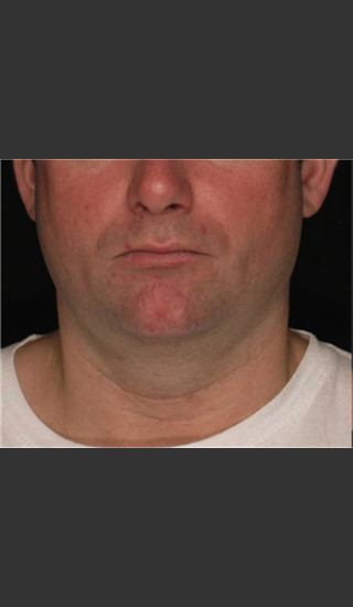 Before Photo for Treatment of Neck with Laser Liposuction -  - Prejuvenation