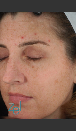 Before Photo for Full Face Treatment of Skin Pigmentation - Brian D. Zelickson, M.D. - Prejuvenation