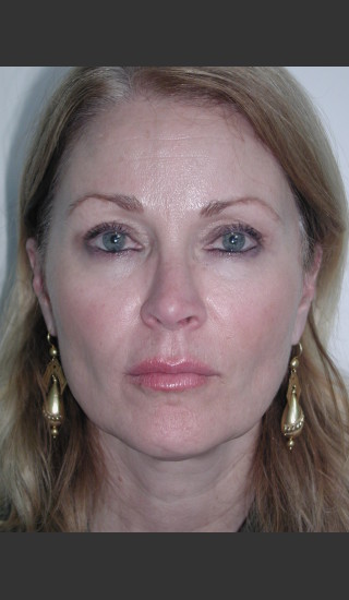 Before Photo for Sculptra for Facial Volume Restoration - James Newman - Prejuvenation