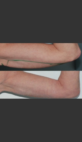 After Photo for Submental and arm localized liposuction - Mark B. Taylor, M.D. - Prejuvenation