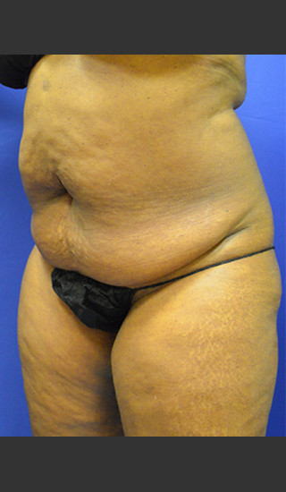 Before Photo for Tummy Tuck Case #1 - Paul C. Dillon, MD - Prejuvenation