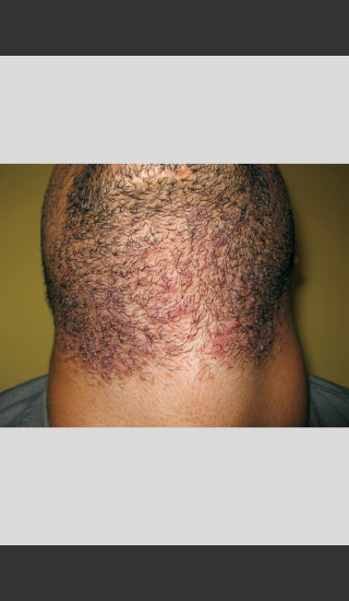 Before Photo for Gentle Laser Hair Removal of Beard Bumps -  - Prejuvenation