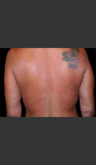 After Photo for Body Contouring Treatment #113 -  - Prejuvenation