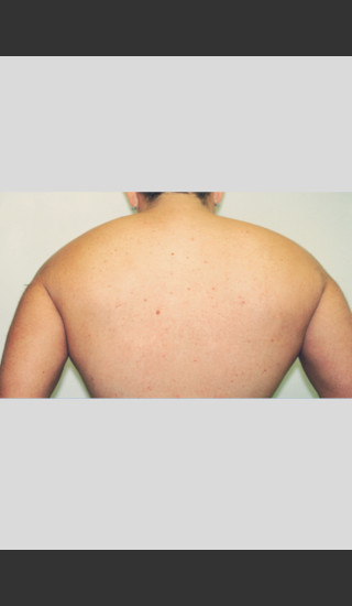 After Photo for Gentle Laser Hair Removal -  - Prejuvenation