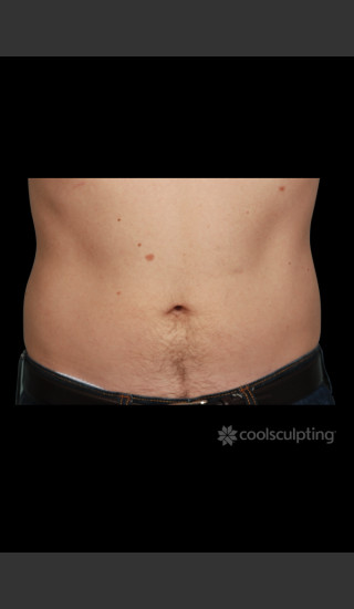 After Photo for CoolSculpting Before & After on Man -  - Prejuvenation