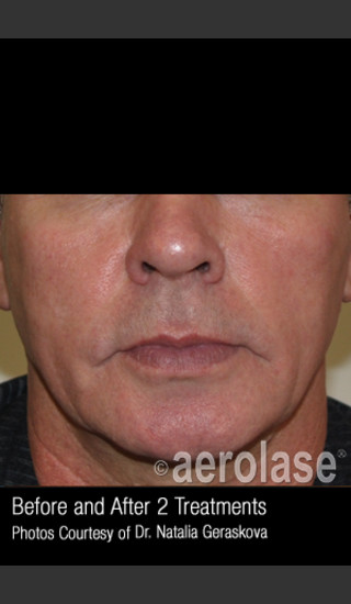 After Photo for Treatment of Facial Blood Vessels #324 -  - Prejuvenation