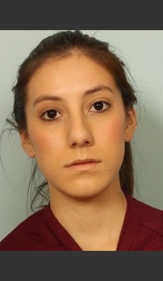 Before Photo for Rhinoplasty Surgery - El Paso Cosmetic Surgery - Prejuvenation
