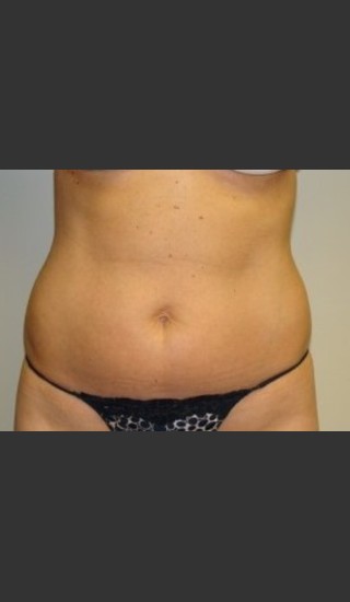 Before Photo for Liposuction of Abdomen 8087 - Sanjay Grover MD FACS - Prejuvenation