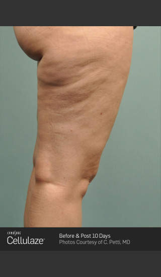 Before Photo for Cellulaze Cellulite Treatment of the Thighs -  - Prejuvenation