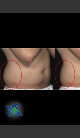 Before Photo for Treatment of Right Flanks with CoolSculpting - Roy G. Geronemus, M.D. - Prejuvenation