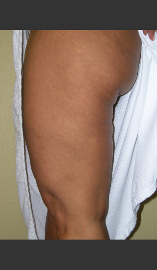 After Photo for 3DEEP Thigh Cellulite Reduction -  - Prejuvenation