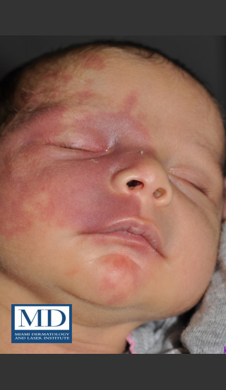 Before Photo for Port Wine Stain Treatment 103 - Jill S. Waibel, MD - Prejuvenation