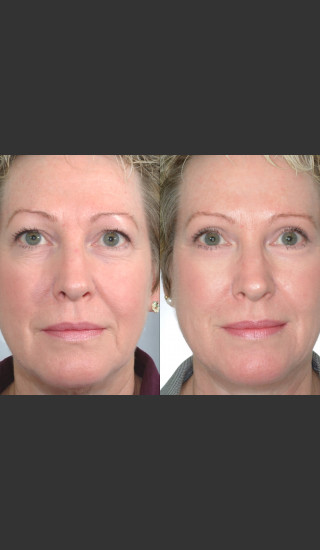 Before Photo for Two women with Laser Eyelid Blepharoplasty - Mark B. Taylor, M.D. - Prejuvenation