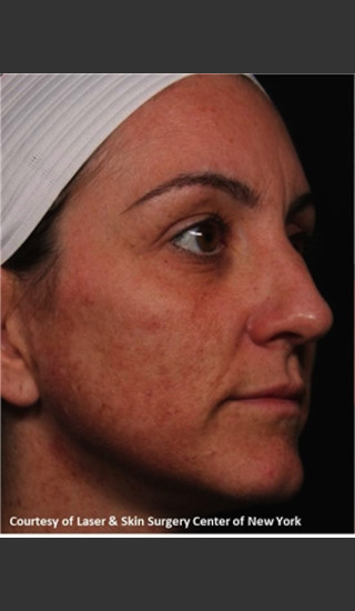 Before Photo for Full face Treament with Fraxel - Roy G. Geronemus, M.D. - Prejuvenation