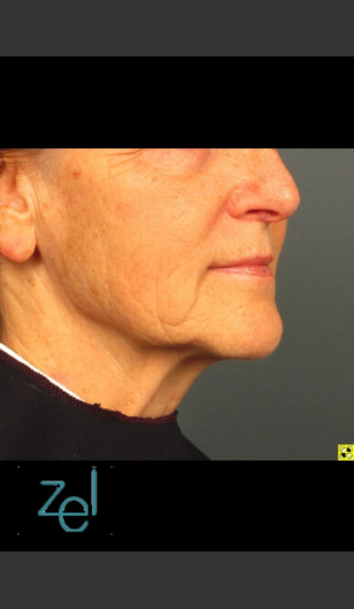 After Photo for Lower Face Ultherapy & Dermal Fillers - Brian D. Zelickson, M.D. - Prejuvenation