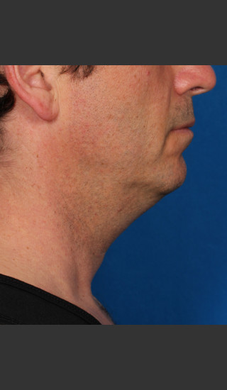 Before Photo for Kybella Treatment 47 Year Old Male -  - Prejuvenation
