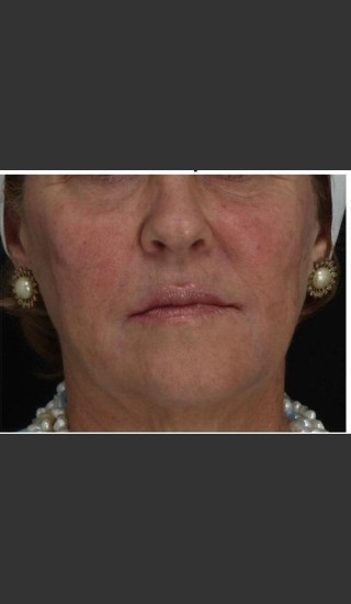 After Photo for Immediate Lifting of Corners of the Mouth after Juvederm Ultra injection (effect is immediately after injection) - Leyda Elizabeth Bowes, M.D. - Prejuvenation
