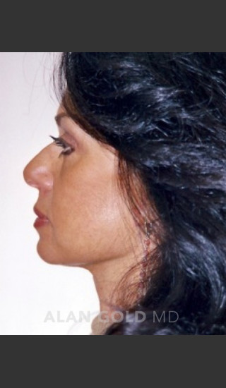 After Photo for Rhytidectomy (Facelift) 1884 Side View - Alan Gold MD - Prejuvenation