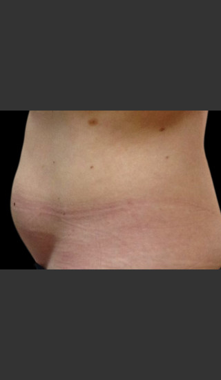 Before Photo for Body Contouring Treatment #117 -  - Prejuvenation