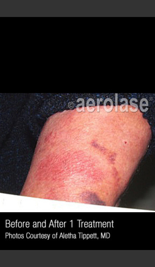 Before Photo for Treatment of Psoriasis #334 -  - Prejuvenation