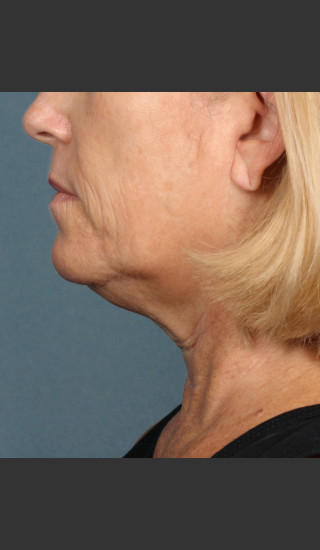 Before Photo for Kybella Treatment 54 Year Old Female -  - Prejuvenation