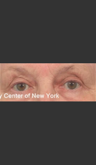 After Photo for Treatment of Fine lines and Wrinkles -  - Prejuvenation