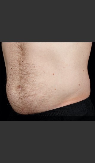 After Photo for SculpSure Abdomen - Sean Doherty - Prejuvenation