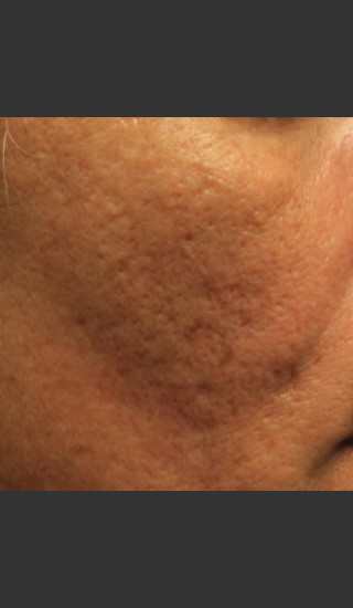 Before Photo for Infini Acne Scar Treatment #12 -  - Prejuvenation