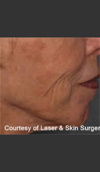 Before Photo for Treatment of Fine lines and Wrinkles -  - Prejuvenation