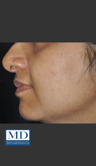 After Photo for Post Inflammatory Hyperpigmentation 120 - Jill S. Waibel, MD - Prejuvenation