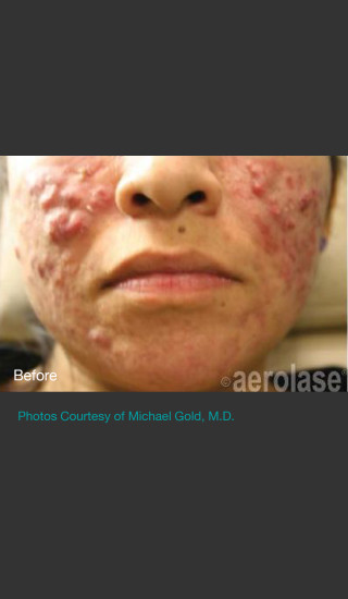 Before Photo for NeoClear by Aerolase Acne Treatment - Michael H Gold - Prejuvenation