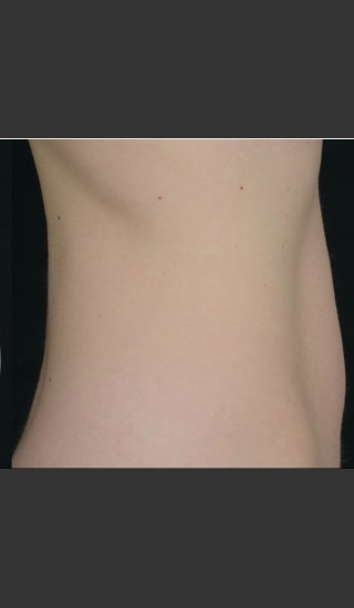After Photo for SculpSure Abdomen -  - Prejuvenation