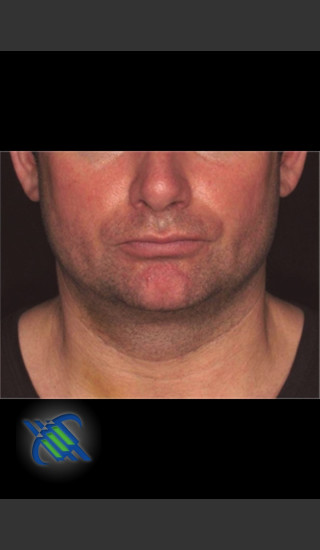 After Photo for Treatment of Male Neck with Laser Liposuction - Roy G. Geronemus, M.D. - Prejuvenation