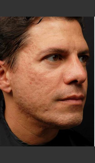 Before Photo for Infini Acne Scar Treatment -  - Prejuvenation